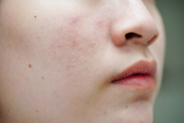 Acne pimple and scar on skin face, disorders of sebaceous glands, teenage girl skincare beauty problem.