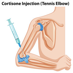 Wall Mural - Cortisone Injection (Tennis Elbow) diagram
