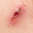 © schankz - Wound on human skin. Macro