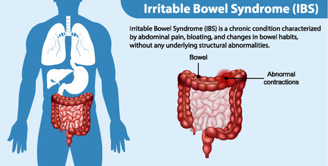 Poster - Irritable Bowel Syndrome (IBS) Infographic