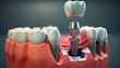 Dental implantat 3D. Generative AI
