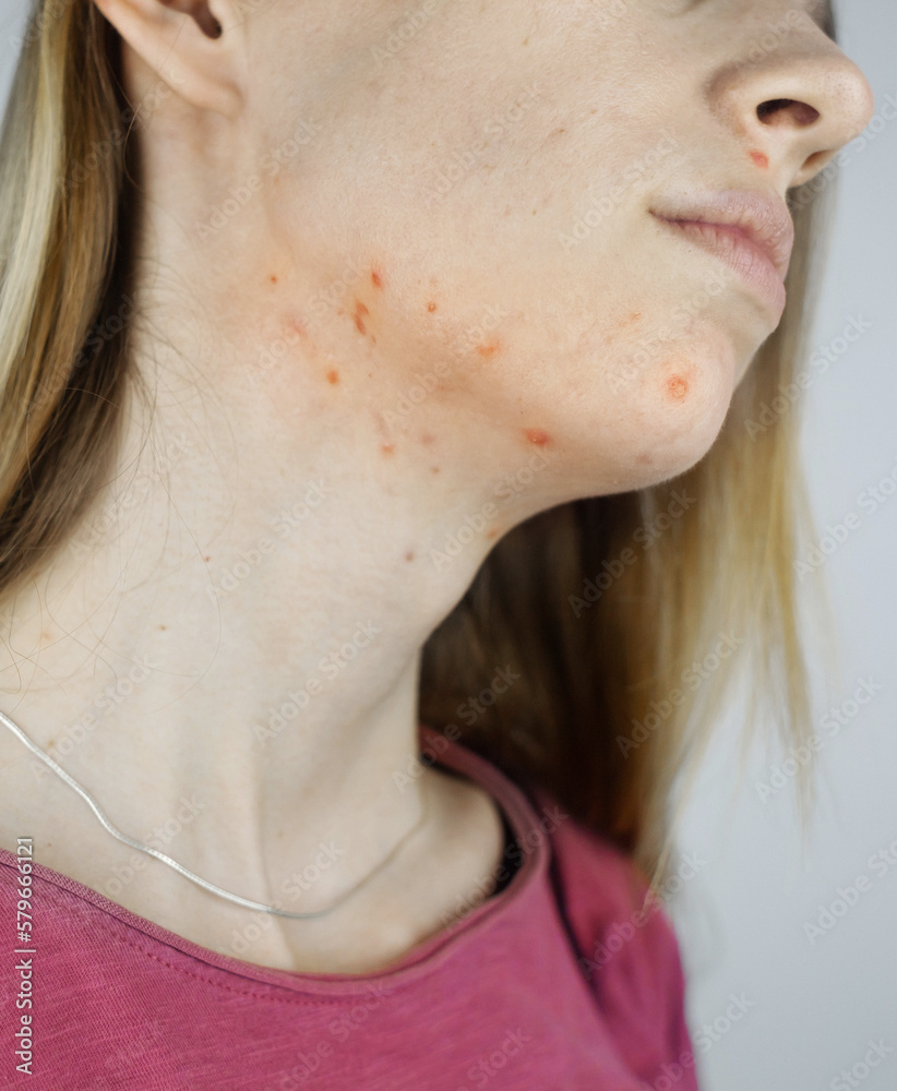 Hormonal Acne Treatment in Delhi - Iksana Wellness - Acne Treatment For Acne On Neck