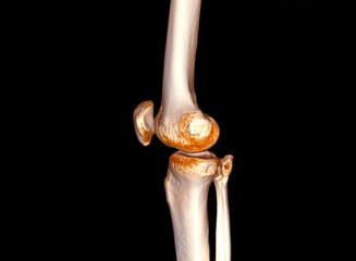 Poster - ct scan of knee joint 3d rendering .