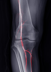 Poster - x-ray image of knee joint fusion with cta femoral run off .
