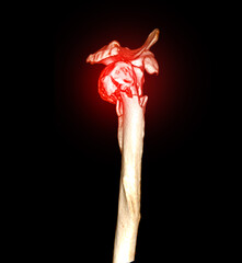 Poster - CT scan 3D rendering of Left shoulder showing fracture head of humerus .