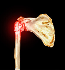 Poster - CT scan 3D rendering of Left shoulder showing fracture head of humerus .