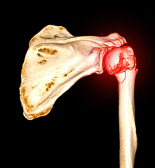 Poster - CT scan 3D rendering of Left shoulder showing fracture head of humerus .