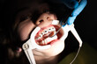 © Minet - Close up of girl with brackets receiving dental braces treatment in clinic