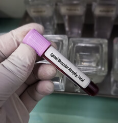 Poster - Blood sample for Spinal Muscular Atrophy(SMA), fetal test, It's an autosomal recessive neurodegenerative disorder.