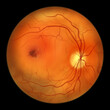 Best vitelliform macular dystrophy, Atrophic stage, retinal atrophy, illustration