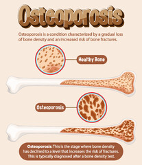 Wall Mural - Informative poster of Osteoporosis human bone