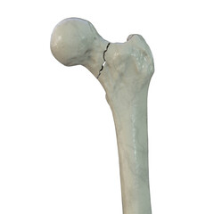 Canvas Print - A fracture of the femur neck, a common type of hip fracture that typically occurs in older adults and can lead to mobility issues and other complications, 3D illustration