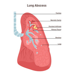 Lung abscess. Microbial infection of the lung causing necrosis of the pulmonary