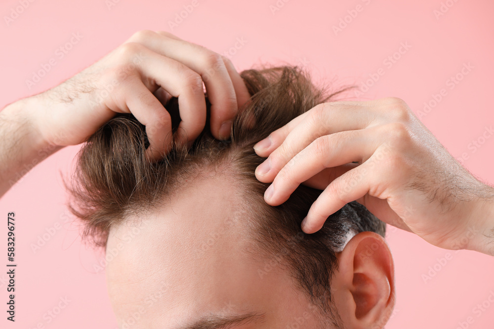 Young man with hair loss problem on pink background, closeup
