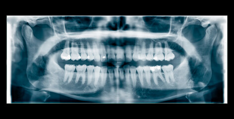 Clear and classical dental x-ray orthopanoramic with several fillings visible on the teeth. No red zone or other changes.