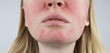 © Siniehina - Rosacea face. The girl suffers from redness on her cheeks. Couperosis of the skin. Redness and capillary mesh are visible on the face. Treatment and removal. Vascular surgery and dermatology