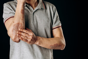 Wall Mural - Acute psoriasis on the elbows is an autoimmune incurable dermatological skin disease. A large red, inflamed, flaky rash on the elbows. Joints affected by psoriatic arthritis