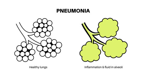 Canvas Print - Pneumonia infection poster