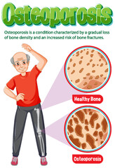 Wall Mural - Informative poster of Osteoporosis human bone