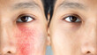 © Alessandro Grandini - Before and after a treatment for rosacea in an asian man's face