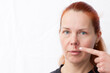 © lilu2005 - Herpes above upper lip in woman. portrait of middle aged woman with problem skin, on light background. woman pointing finger at infectious inflammation of face caused by herpes simplex virus.