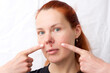 Herpes above upper lip in woman. portrait of middle aged woman with problem skin, on light background. woman pointing fingers at infectious inflammation of face caused by herpes simplex virus.