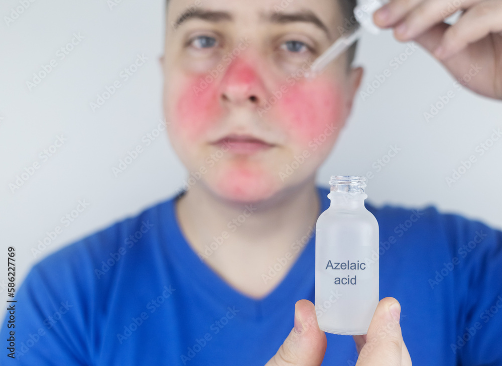 Azelaic acid. Man applies azelainates to her face. Laboratory research ...