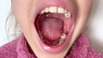 child girl or teenage girl of eleven years old opens the mouth wide and shows the teeth, gums and th