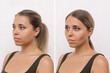 © Марина Демешко - Young blonde woman's face before and after plastic surgery buccal fat pad removal isolated on a white background. A lower part of face with clear highlighted cheekbones. Result of cosmetic surgery