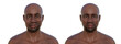 Facial palsy in an African man and the same healthy man, 3D illustration showing the asymmetry and drooping of the facial muscles on one side of the face