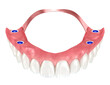 Removable prosthesis based on six implants. Dental 3D illustration