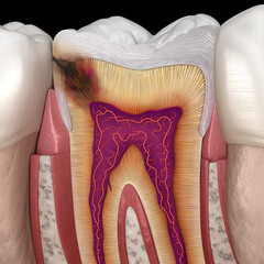 Wall Mural - Hidden caries in to molar tooth. Medically accurate 3D illustration