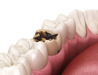 Wall Mural - Molar teeth damaged by caries. Medically accurate tooth 3D illustration.