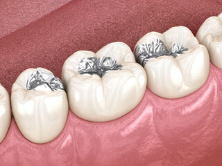 Wall Mural - Amalgam restoration. Medically accurate 3D animation of dental concept