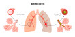 Bronchitis lung disease