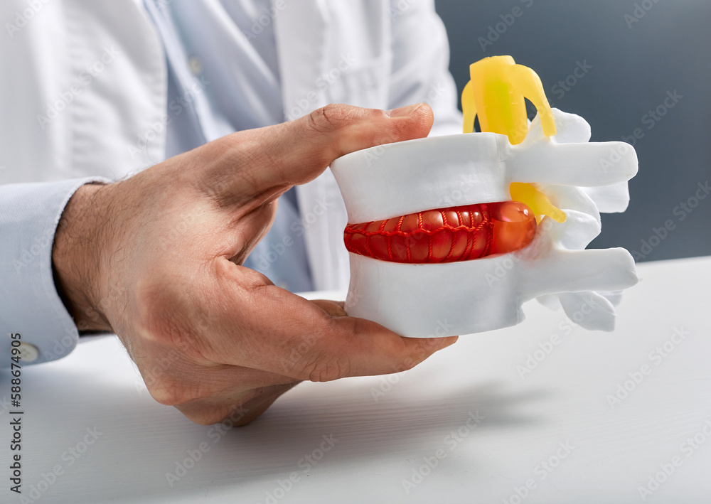 Anatomical lumbar disc herniation model in doctor hand while consultation in medical clinic. Intervertebral hernia treatment