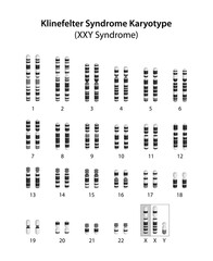 Klinefelter syndrome (XXY syndrome) karyotype.