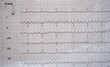 real ecg showing atrial flutter (good to see in serrated waves in II, III and aVF).