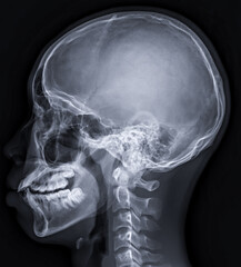 Poster -  x-ray image of Human Skull   lateral view for diagnosis skull fracture  isolated on Black Background.