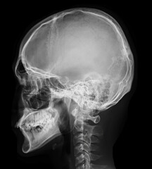 Poster -  x-ray image of Human Skull   lateral view for diagnosis skull fracture  isolated on Black Background.