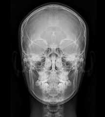 Poster - X-ray image of Human Skull   Front  view for diagnosis skull fracture  isolated on Black Background.