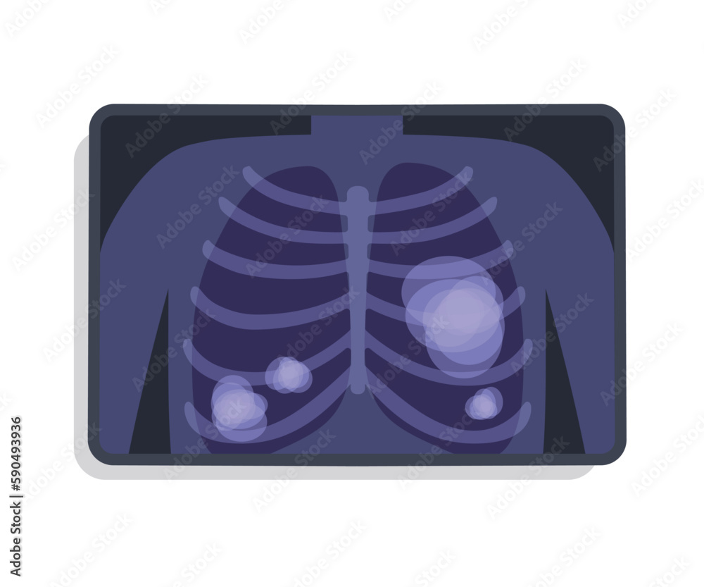 Lung Cancer Xray Image Flat Vector Illustration. Human Chest ...