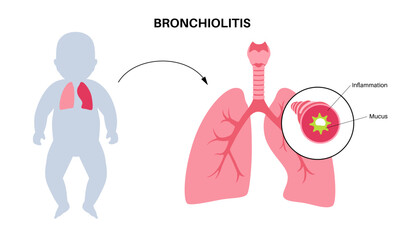 Wall Mural - Bronchiolitis lung disease