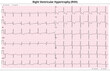 ECG Right Ventricular Hypertrophy (LVH) - Right Ventricular Enlargement - 12 Lead ECG Common Case - 6 Sec/lead - Medical Vector Illustration