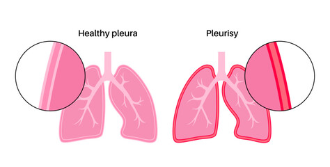 Canvas Print - Pleurisy inflammation diseases