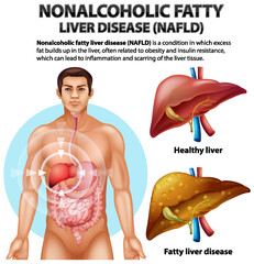 Wall Mural - Nonalcoholic Fatty Liver Disease