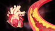 © Rasi - Cholesterol plaque in artery with human heart anatomy. 3d illustration..