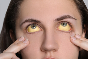 Poster - Woman with yellow eyes on light background, closeup. Symptom of hepatitis