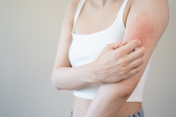 Sensitive skin allergic concept, Woman itching on her arm have a red rash from allergy symptom and from scratching.