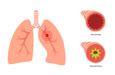 Canvas Print - Bronchitis lung disease